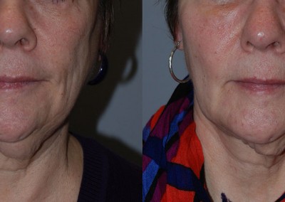 Facial rejuvenation: Progression from pre to post liposuction on face