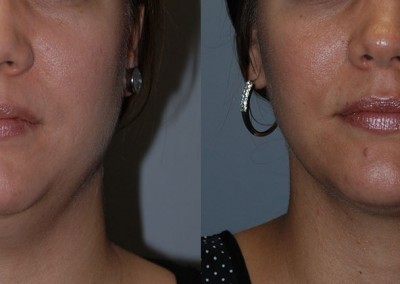 Facial sculpting results: Before and after liposuction procedure
