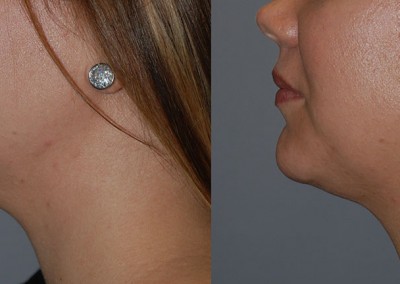 Refinement of facial features: Before vs after facial liposuction