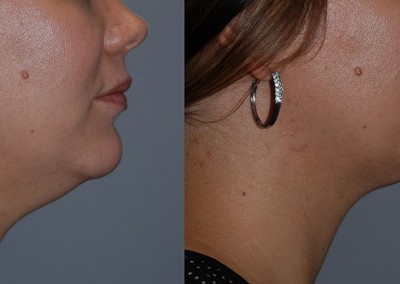 Enhanced facial contours: Transformation post facial liposuction