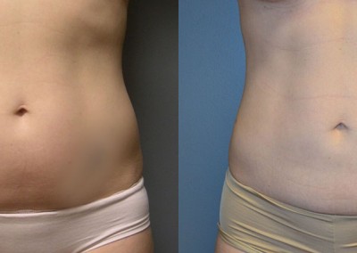 Waistline Transformation: Comparative photos detailing the changes attained through liposuction on the abdomen and waist