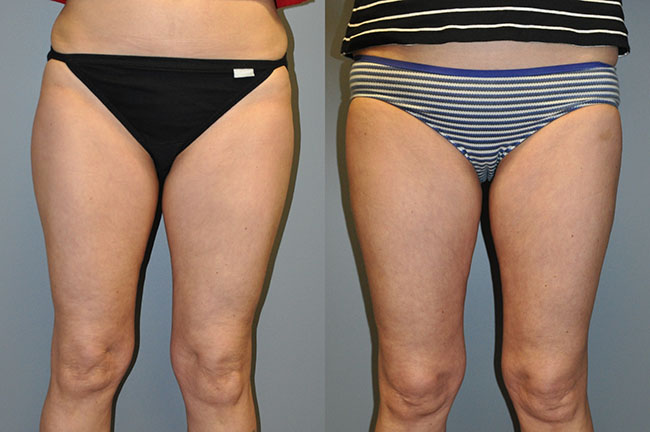 SmartLipo Lateral and Medial Thighs
