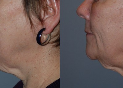 Defined jawline achievement: Comparison of facial liposuction outcomes