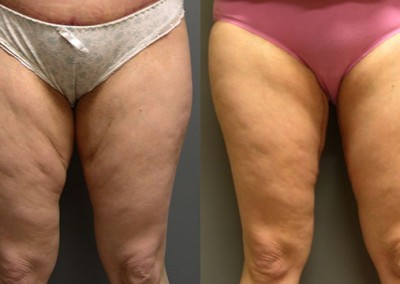 Thigh lift success: Side-by-side comparison of thigh appearance pre and post procedure