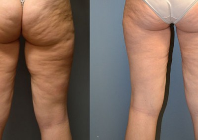 Enhanced thigh contours: Before and after images showcasing the results of Thigh Lift surgery