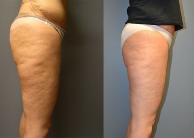 Thigh transformation: Visual comparison of thighs before and after Thigh Lift procedure