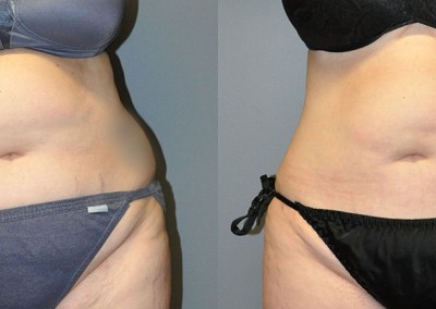 Waistline Refinement: Visual journey from pre-procedure to post-liposuction, emphasizing waist enhancement