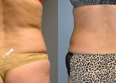Sculpted Silhouette: Visual representation of body contouring through abdomen and waist liposuction