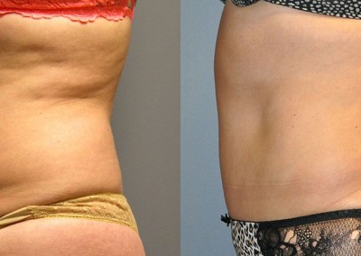 Abdominal Slimming: Side-by-side photos demonstrating the outcomes of liposuction on the midsection