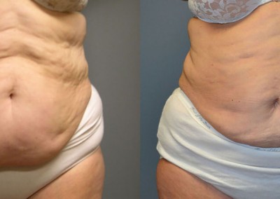 Midriff Sculpting: Transformational images detailing the contour refinement achieved with liposuction on abdomen and waist