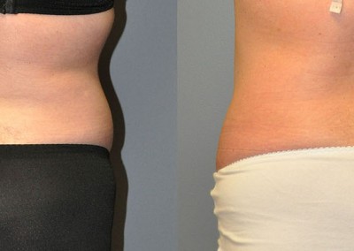 Contoured Midsection: Before-and-after snapshots illustrating the impact of liposuction on abdomen and waist