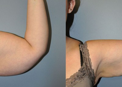 Arm contouring transformation: Visual comparison of arms before and after liposuction procedure