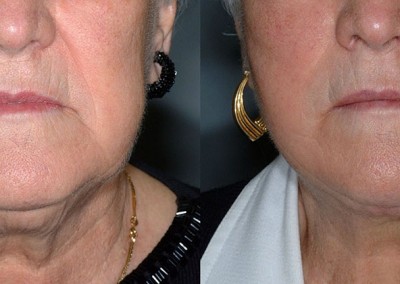 Chin refinement: Visual comparison of neck contouring before and after liposuction
