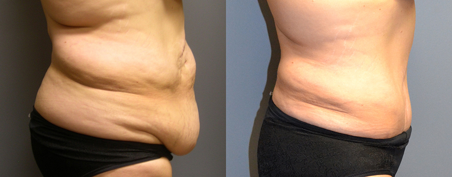 Abdominoplasty with Ultrasound-Assisted Lipoplasty waist and chest