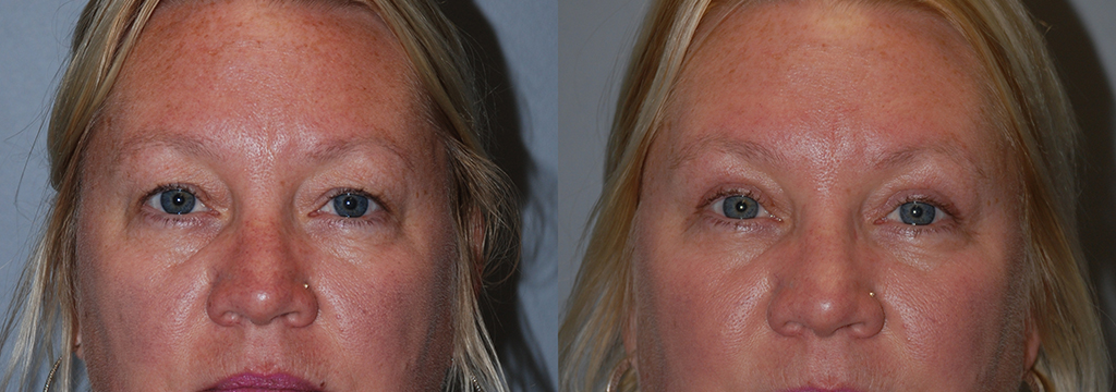 Visible Change: Woman's Eyelid Surgery