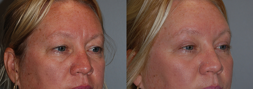 Eyelid Lift Progression: Before and After