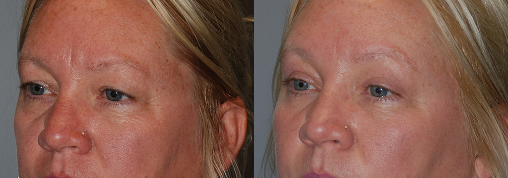 Blepharoplasty Outcome: Woman's Facial Transformation