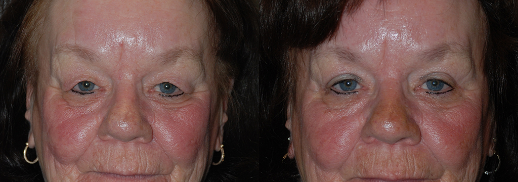 Eyelid Rejuvenation: Before and After
