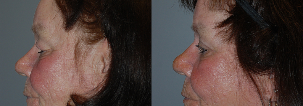 Before and after Blepharoplasty: Woman's Face