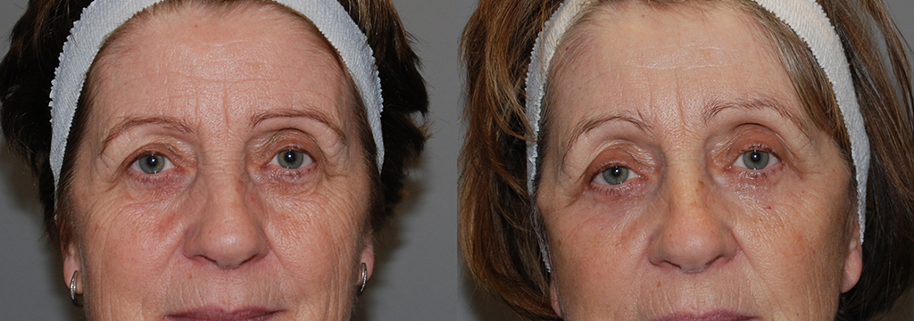 Transformational Eyelid Surgery: Before and After