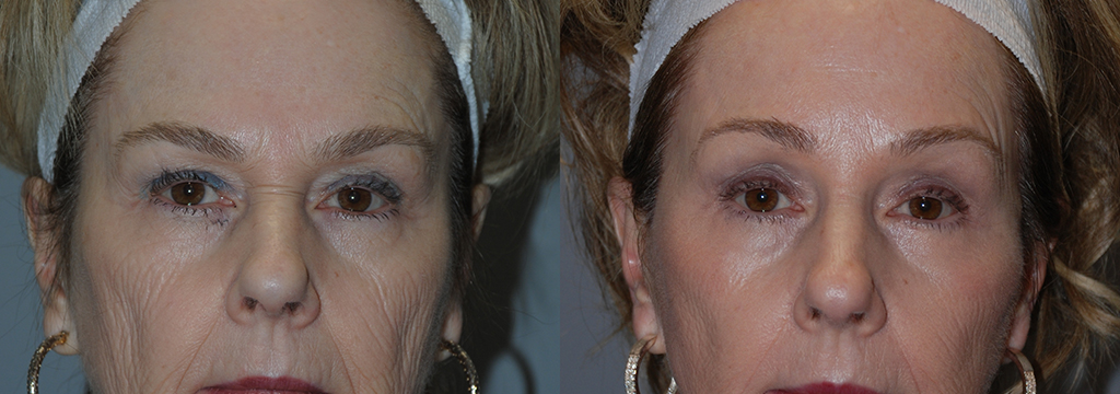 Facial Enhancement: Eyelid Lift Results