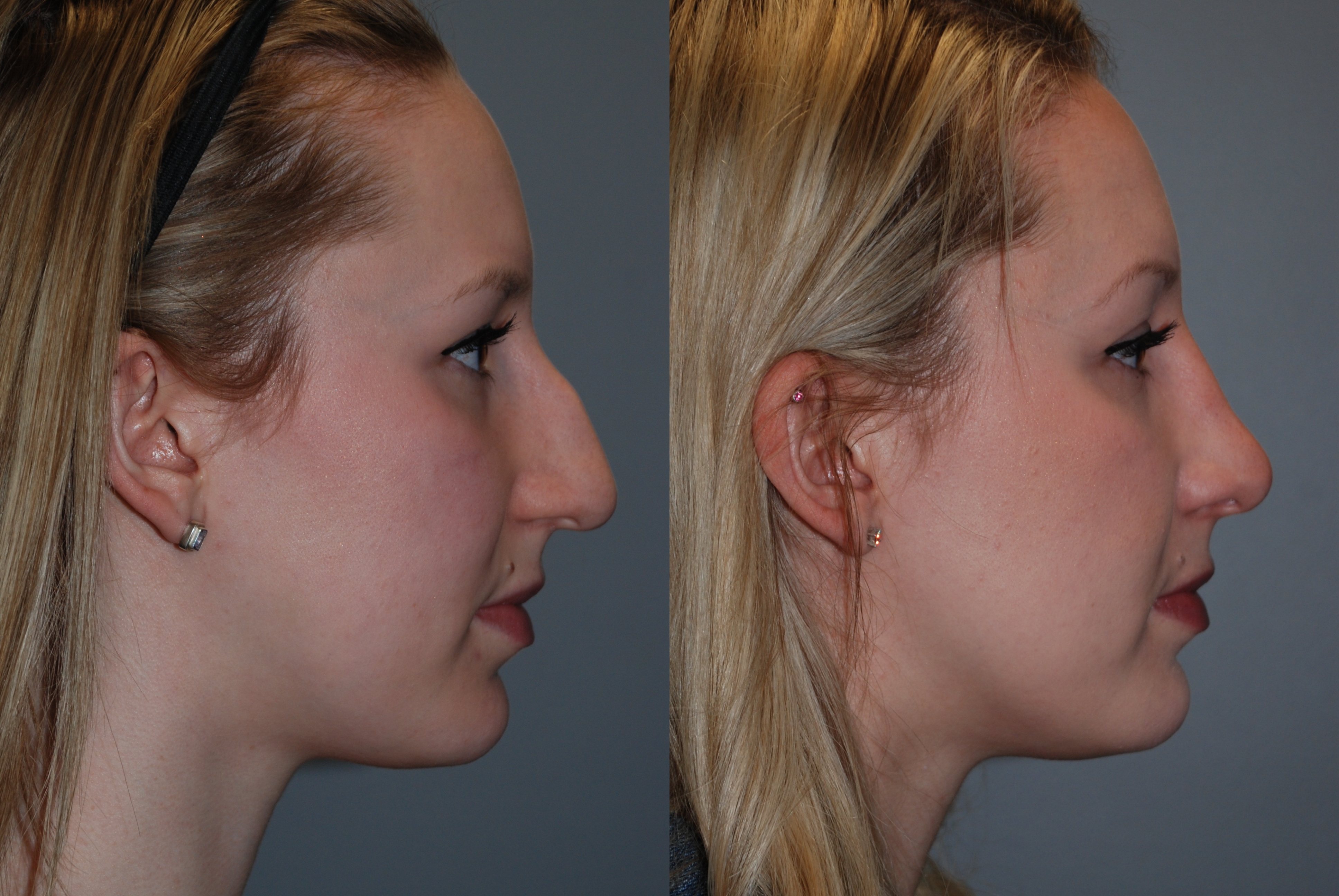 Before and after rhinoplasty: Facial transformation