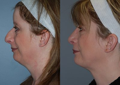 Nasal refinement: Rhinoplasty before and after images