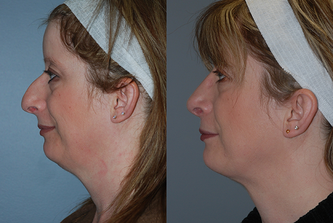 Nasal refinement: Rhinoplasty before and after images