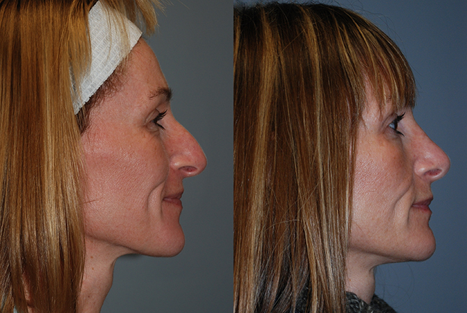 Rhinoplasty transformation: Enhanced facial features