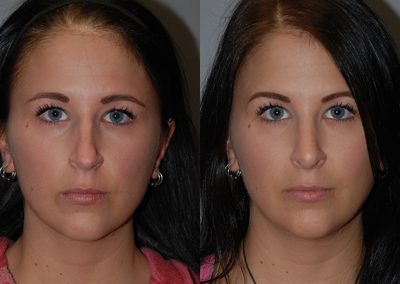 Nose reconstruction: Before and after rhinoplasty