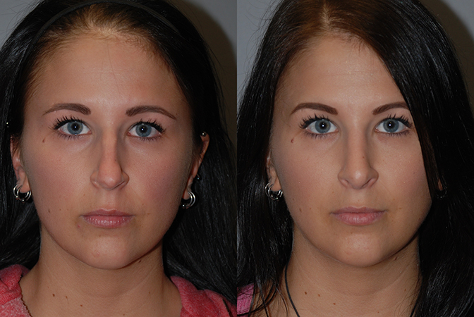 Nose reconstruction: Before and after rhinoplasty