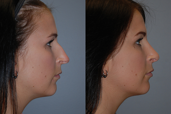 Improved facial aesthetics: Rhinoplasty progression