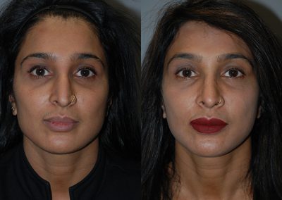 Facial harmony restored: Rhinoplasty outcome