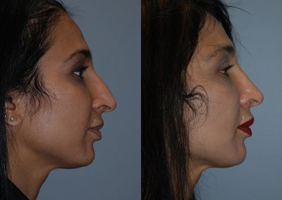 Nasal reshaping success: Before and after surgery