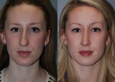 Enhanced nasal profile: Rhinoplasty results
