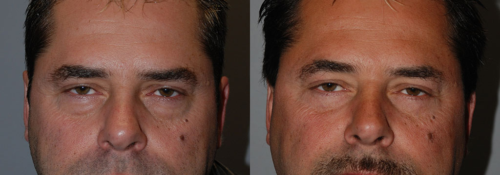 Brighter Gaze: Blepharoplasty Before and After