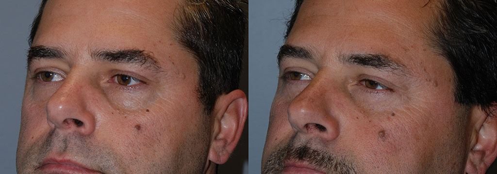 Eyelid Rejuvenation: Before and After Procedure