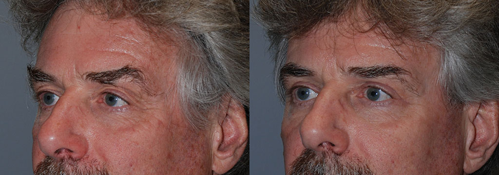 Youthful Eyes: Blepharoplasty Before and After