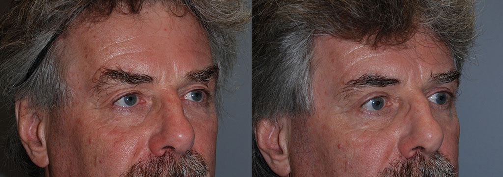Eyelid Transformation: Before and After Blepharoplasty