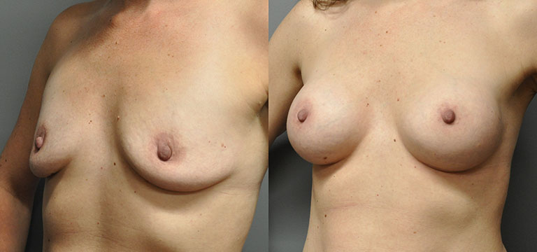 breast-augmentation-21