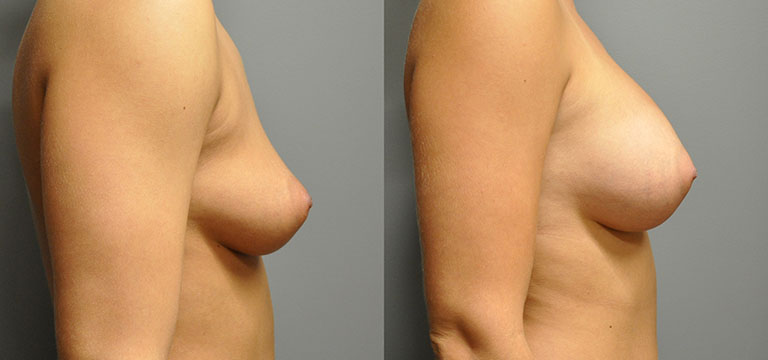 breast-augmentation-37