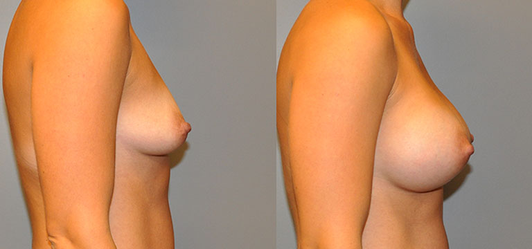 breast-augmentation-4