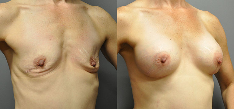 breast-augmentation-56