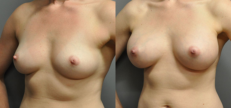 breast-augmentation-8