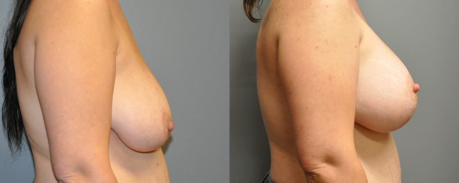 Breast Augmentation and Mastopexy