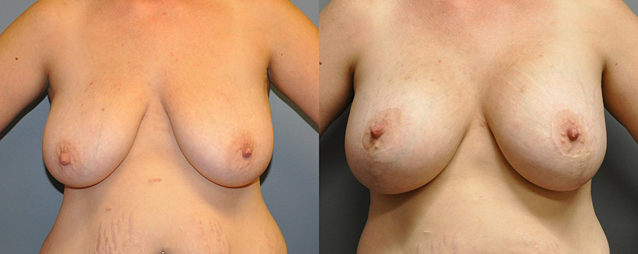 Breast Augmentation and Mastopexy