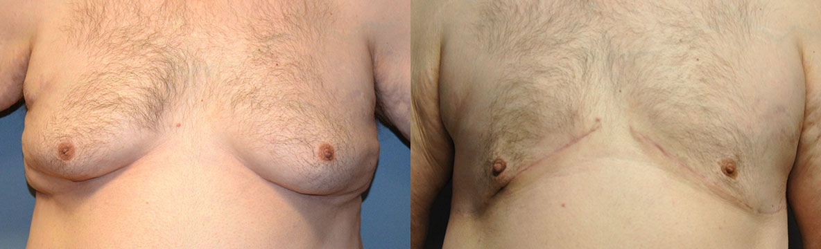 Gynaecomastia Transformation: Male Chest Before and After