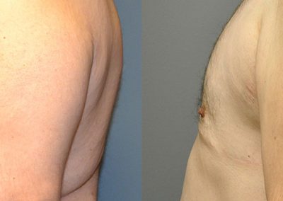 Improved Contour: Before and After Gynaecomastia Treatment