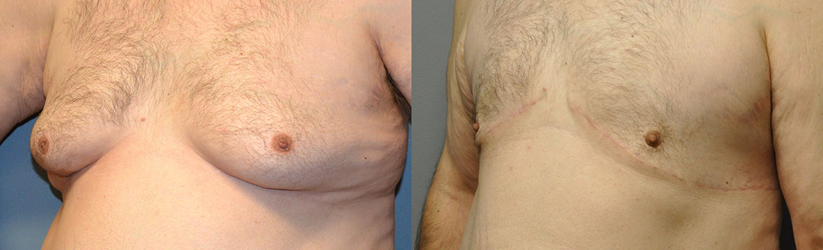 Visible Change: Male Chest Before and After Procedure