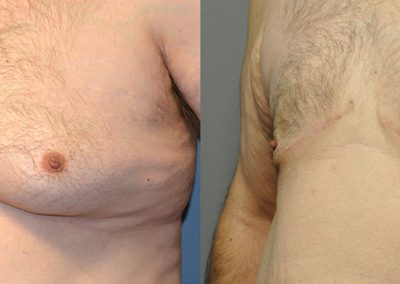 Gynaecomastia Surgery Outcomes: Before and After
